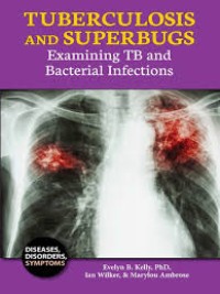 Tuberculosis and Superbugs. Examining TB and Bacterial Infections